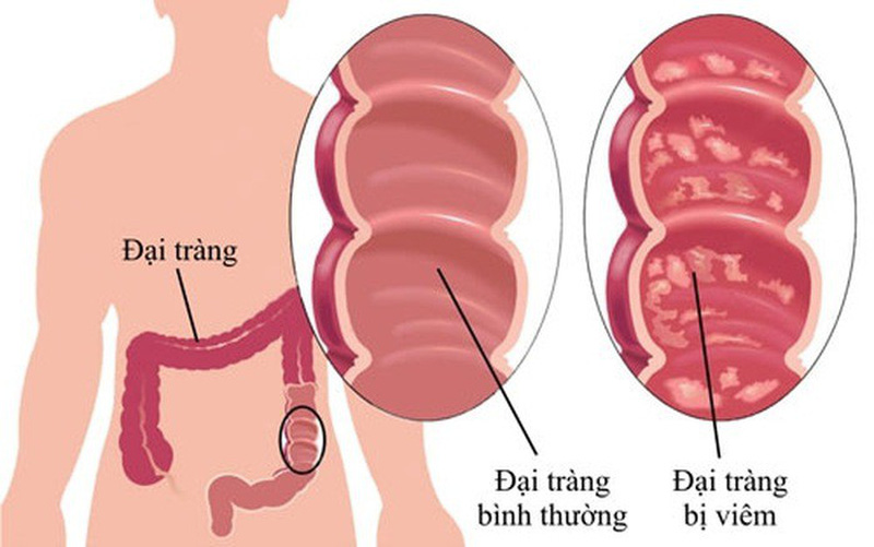 Hội chứng loét trực tràng đơn độc - Hình ảnh minh họa